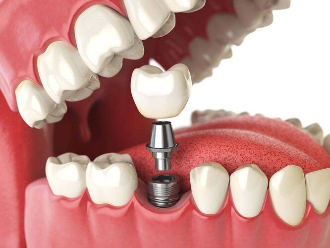 چگونه دندان های از دست رفته را جایگزین کنیم؟