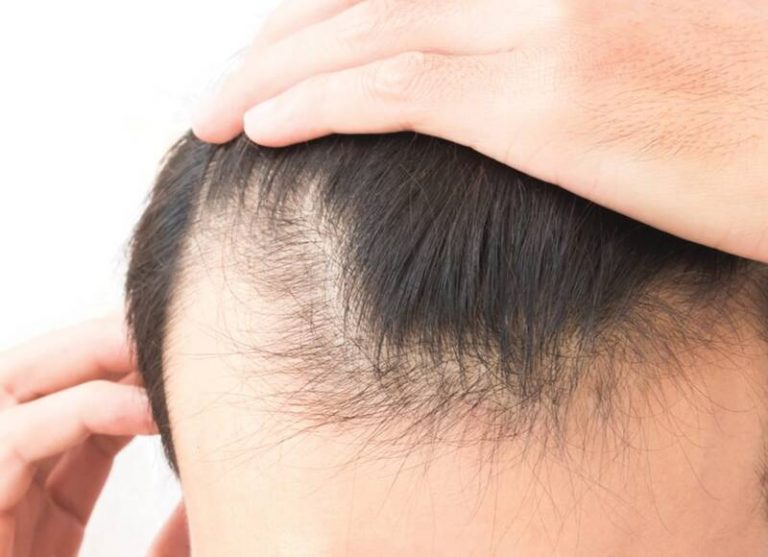 راهکارهای طب سنتی برای جلوگیری از ریزش مو