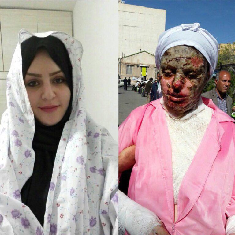 هیچ یک از وعده های مسئولین عملی نشد؛ روایتی از معصومه جلیل پور، قربانی اسیدپاشی در تبریز – خبرگزاری…