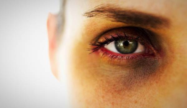چرا زیر چشم ها تیره میشه؟